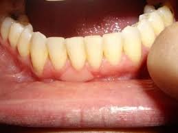 Healthy Gums Vitamins
